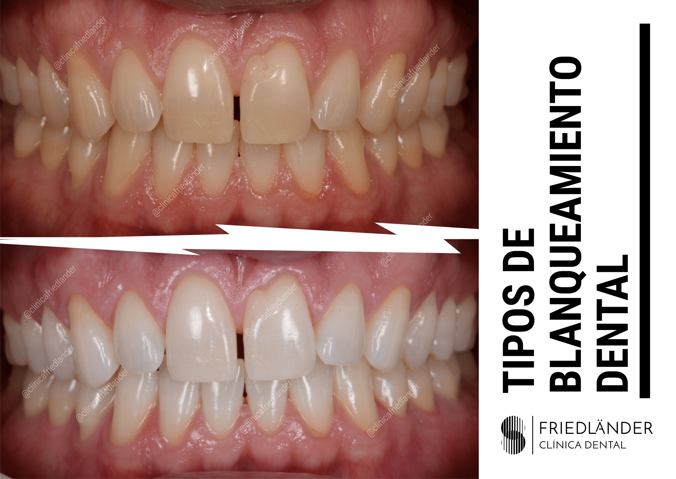 Tipos de blanqueamiento dental