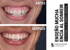 enseño mucha encia al sonreir