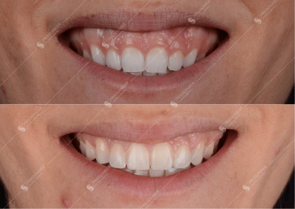 Paciente con sonrisa gingival tratada con ortodoncia por el Dr. Itamar Friedländer y alargamiento de corona por la Dra. Marta Montserrat