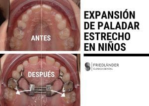 expansion-paladar-estrecho-en-ninos