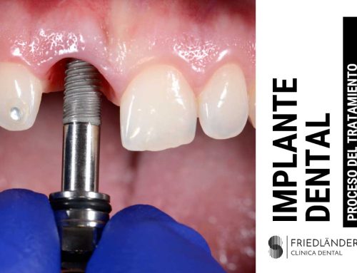 ¿Cómo es el proceso completo para colocar implantes dentales?