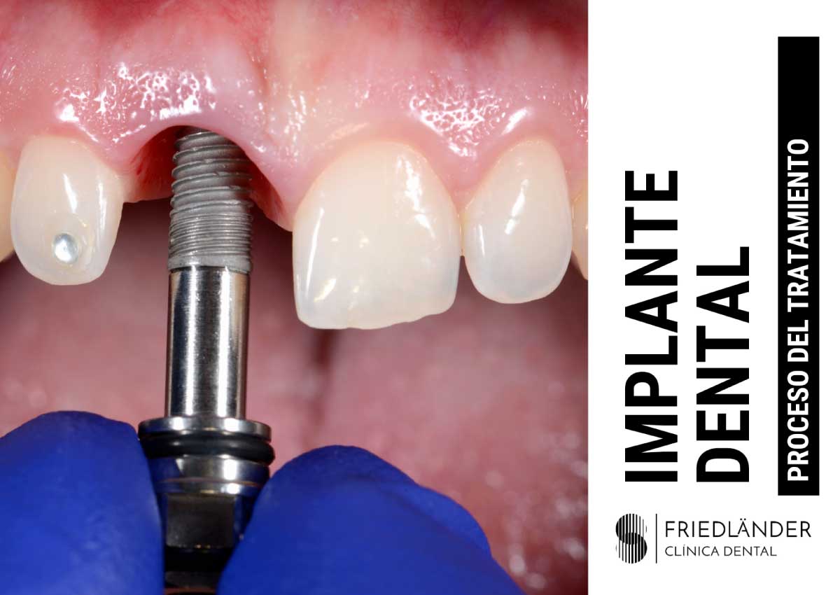 implantes dentales proceso