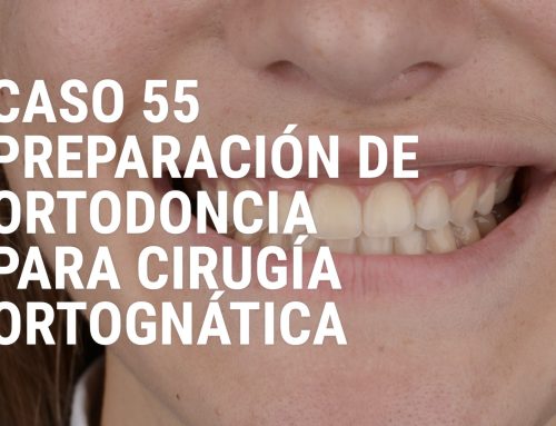 Caso 55 – Preparación de Ortodoncia para Cirugía Ortognática