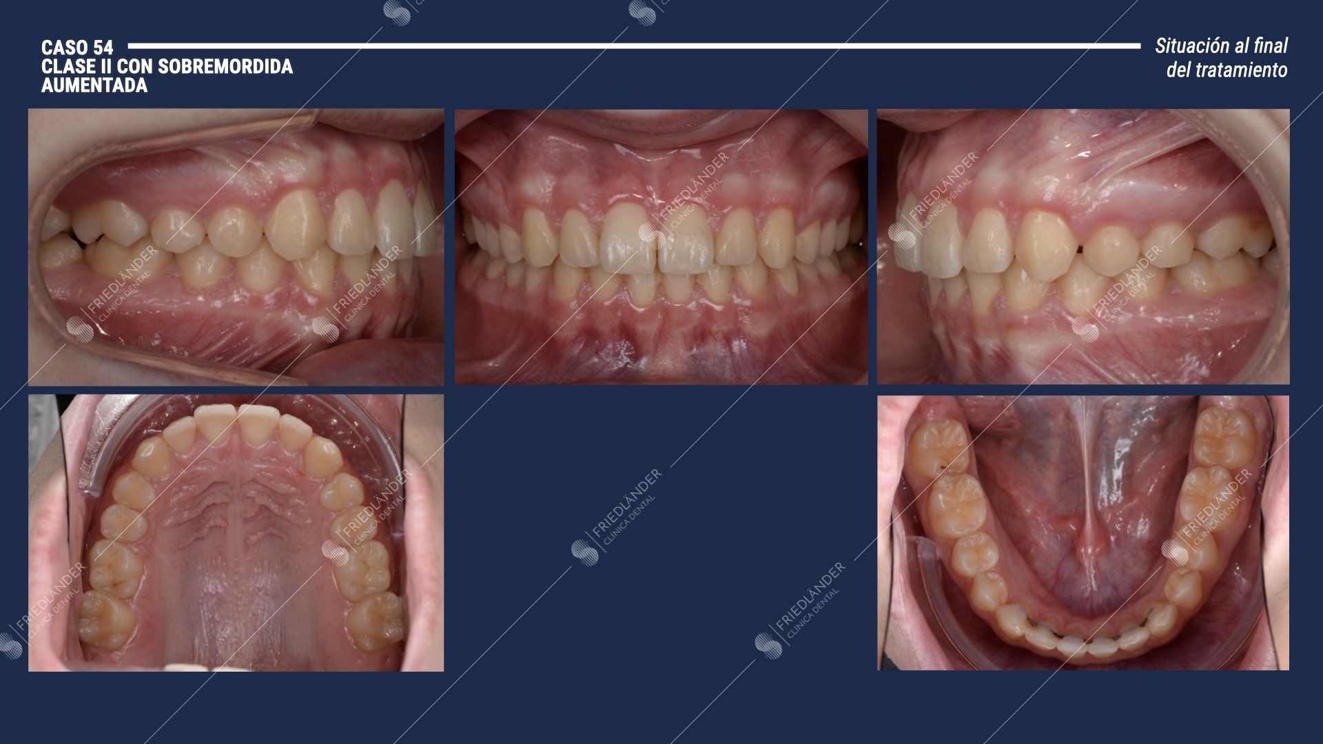 microtornillos de ortodoncia para tratar clase II