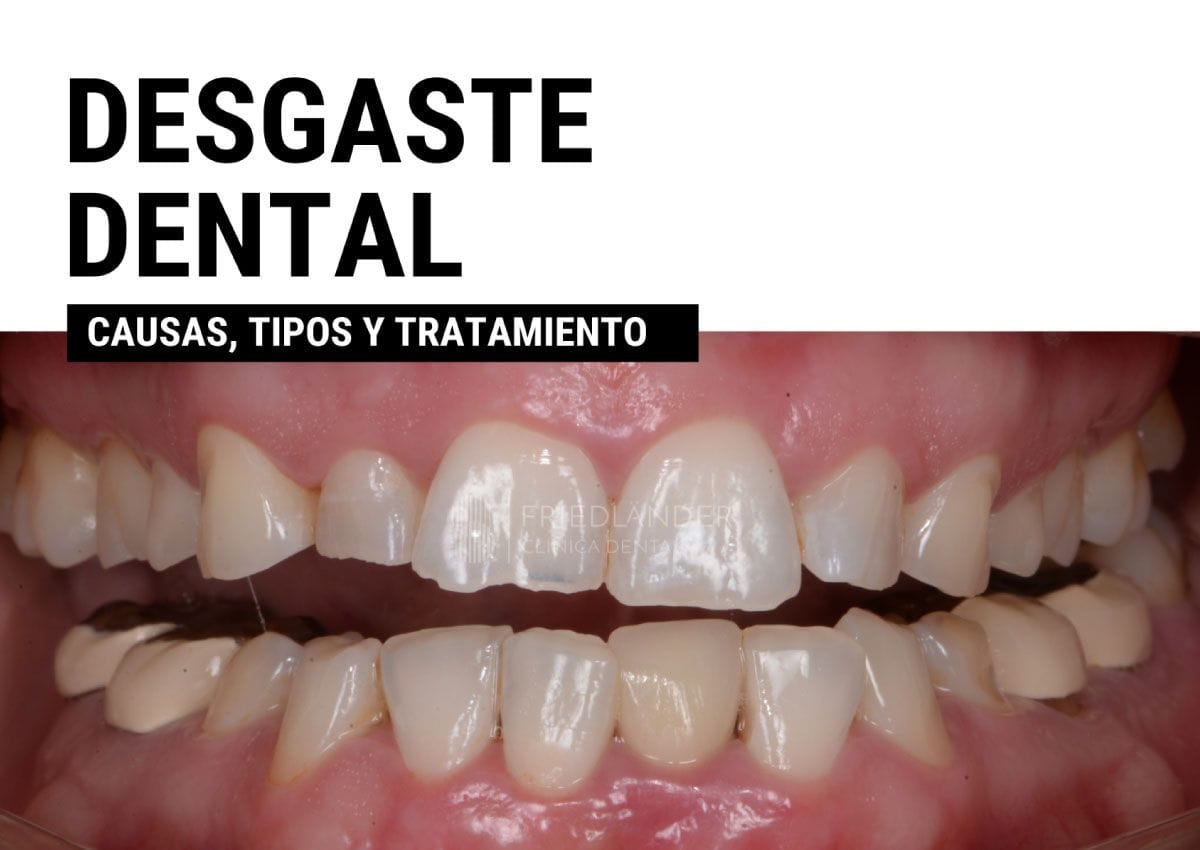 desgaste dental