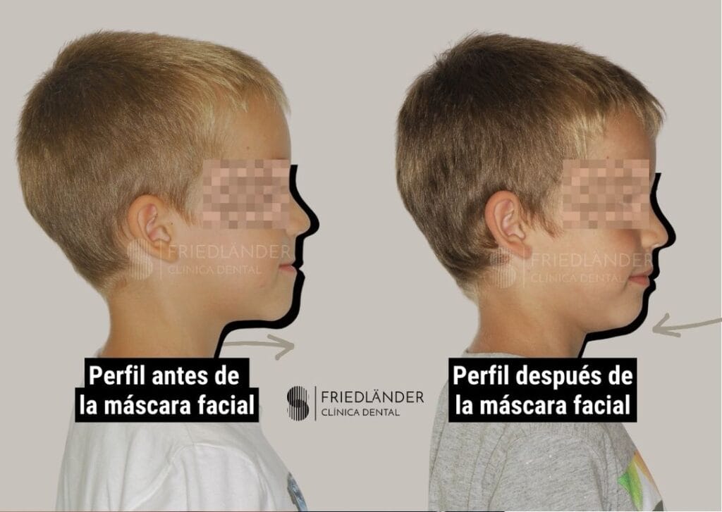 mascara facial en ortodoncia antes y despues