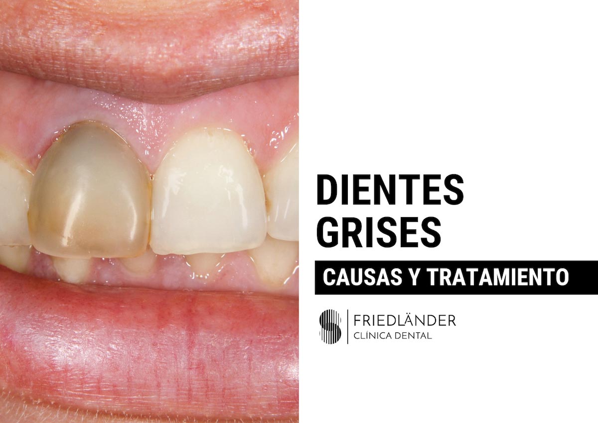 causas y tratamiento de los dientes grises