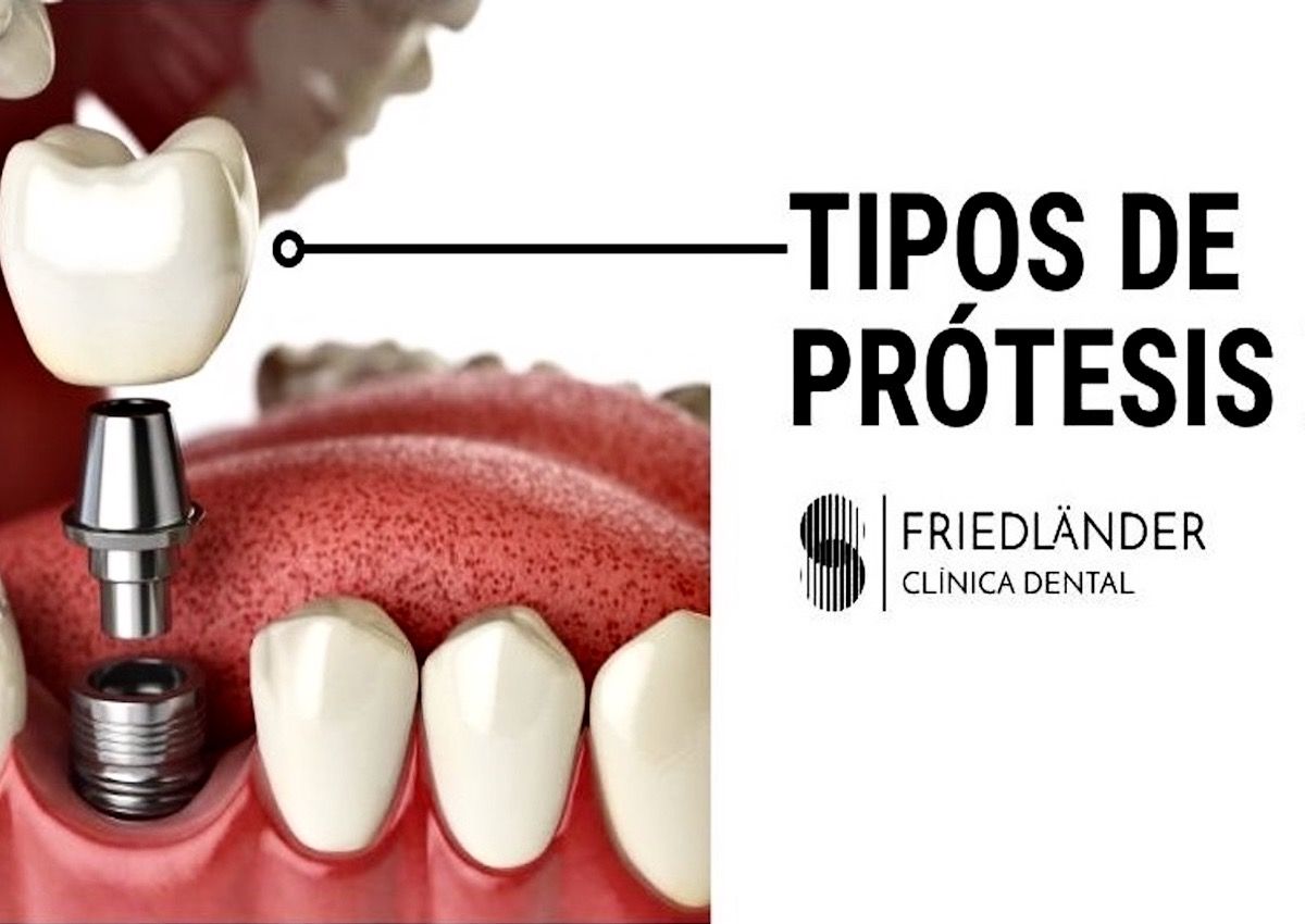 tipos de prótesis dental