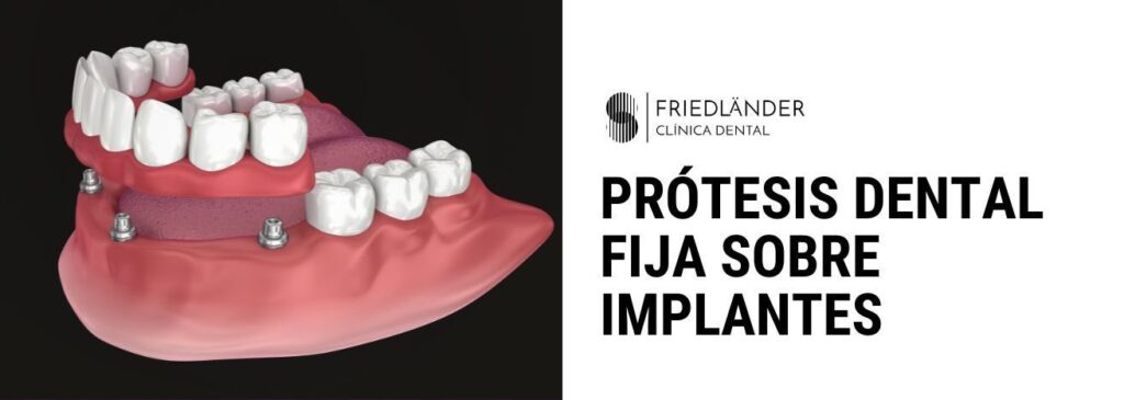 protesis fija sobre implantes