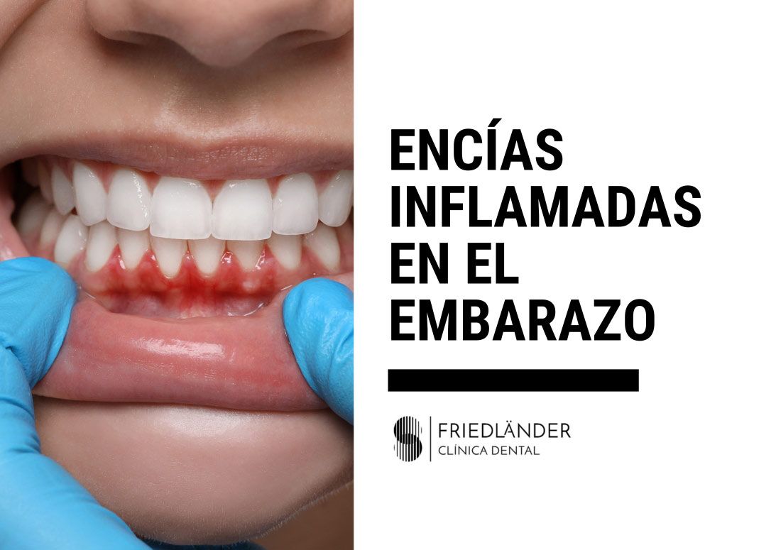 encías inflamadas en el embarazo