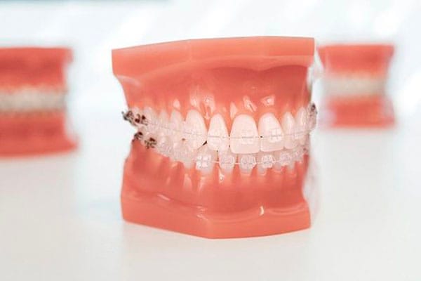 Ortodoncia brackets barcelona • Brackets zafiro