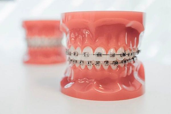 Ortodoncia brackets barcelona • Brackets metálicos