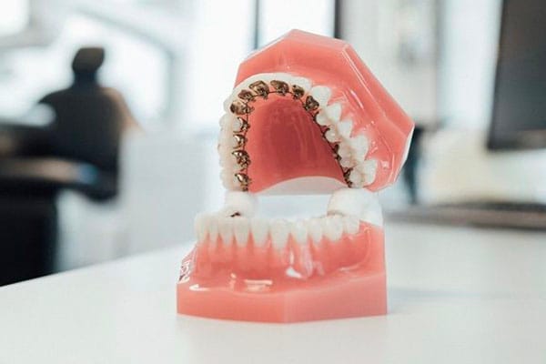 Ortodoncia brackets barcelona • Brackets linguales