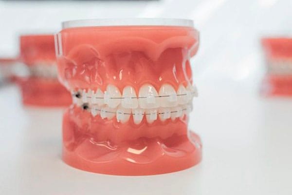 Ortodoncia brackets barcelona • Brackets cerámicos