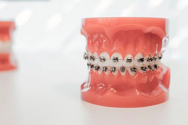 Ortodoncia brackets barcelona • Brackets autoligables