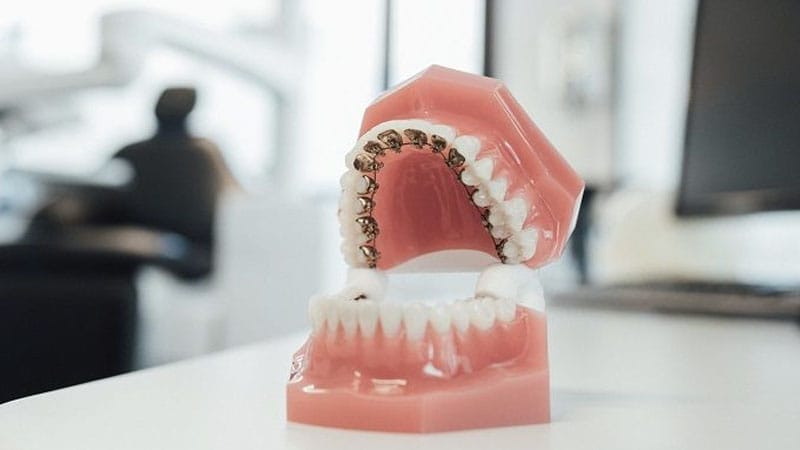 Ortodoncia Lingual Barcelona - Discreción total