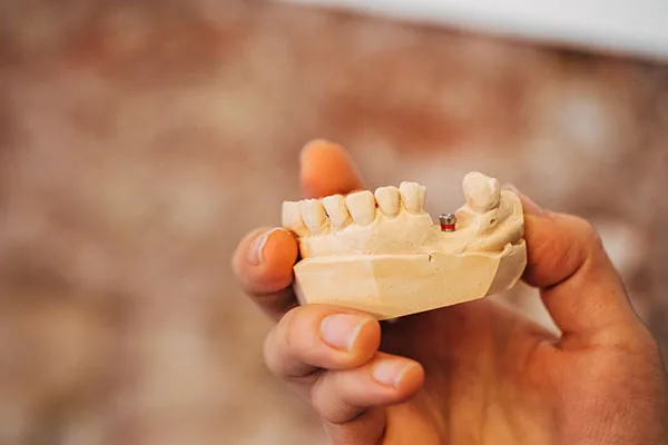 Clínica Friedländer Barcelona • Implantes dentales