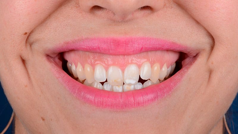 Ortodoncia Quirúrgica Barcelona - Sonrisa gingival