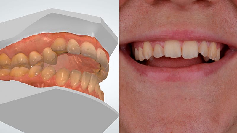 Ortodoncia Quirúrgica Barcelona - Mordida abierta