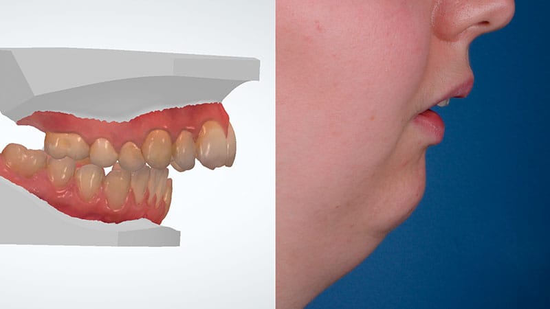 Ortodoncia Quirúrgica Barcelona - Mandíbula retraída