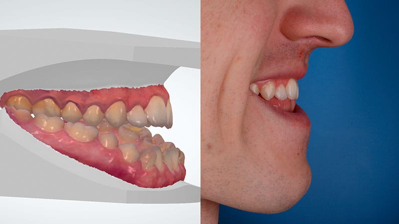 Ortodoncia Quirúrgica Barcelona - Mandíbula prominente