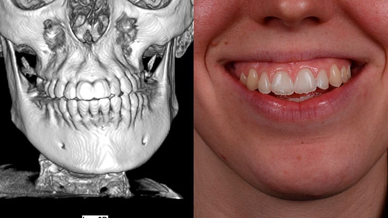 Ortodoncia Quirúrgica Barcelona - Asimetría facial