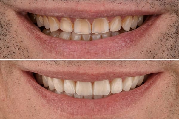 Estética Dental Barcelona - Carillas dentales