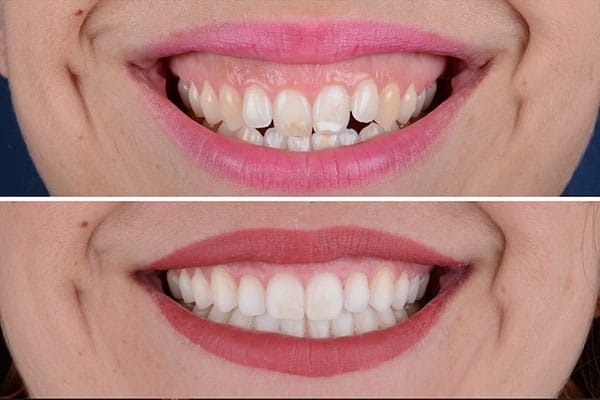 Estética Dental Barcelona - Diseño de sonrisa
