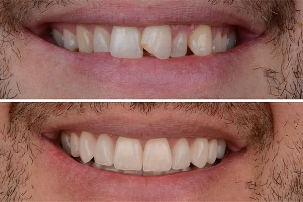 Estética Dental Barcelona - Ortodoncia estética