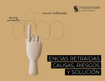 Encías retraídas: causas, factores de riesgo y solución.