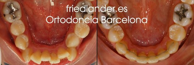 extraccion dental en ortodoncia