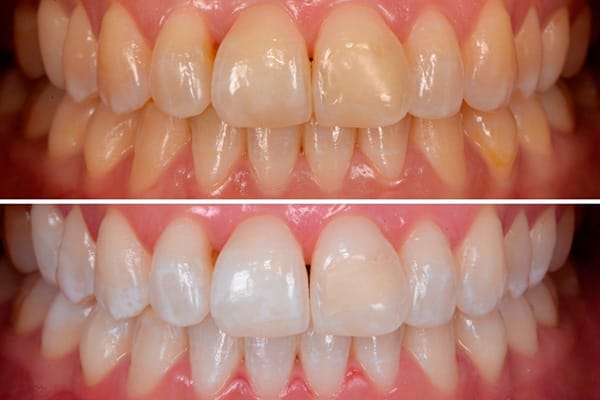 Estética Dental Barcelona - Blanqueamiento dental