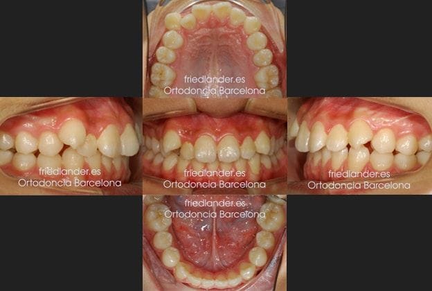 Tratamiento con distalización con autoligado y microtornillos (Clase II) – Caso 27