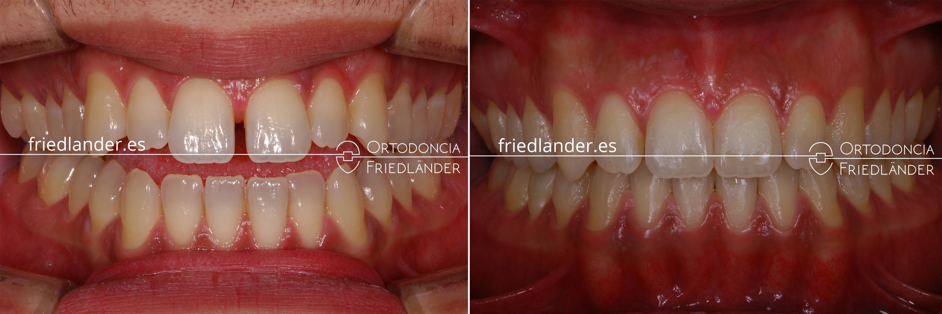 Ortodoncia Friedlander Barcelona mordida abierta antes y despues
