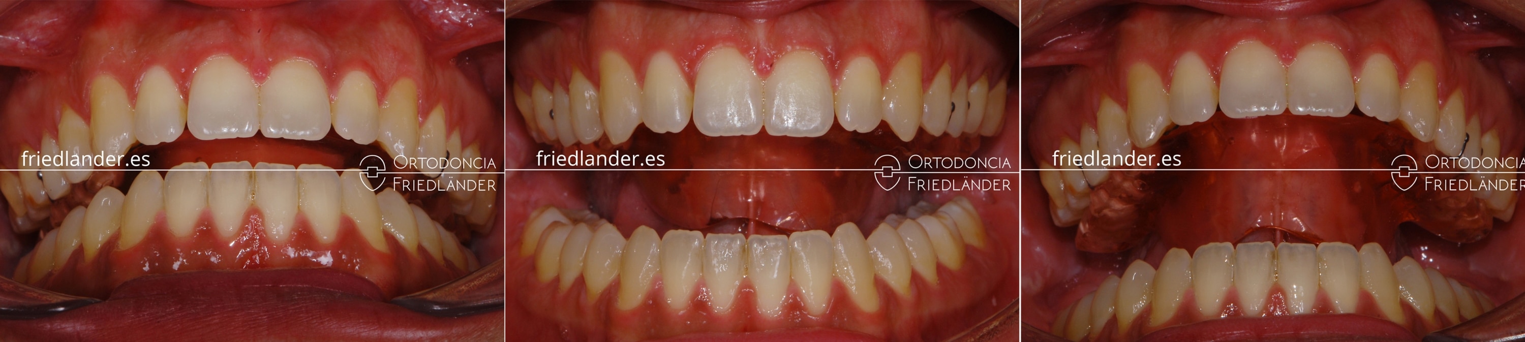 Ortodoncia Friedlander Barcelona mordida abierta microtornillos