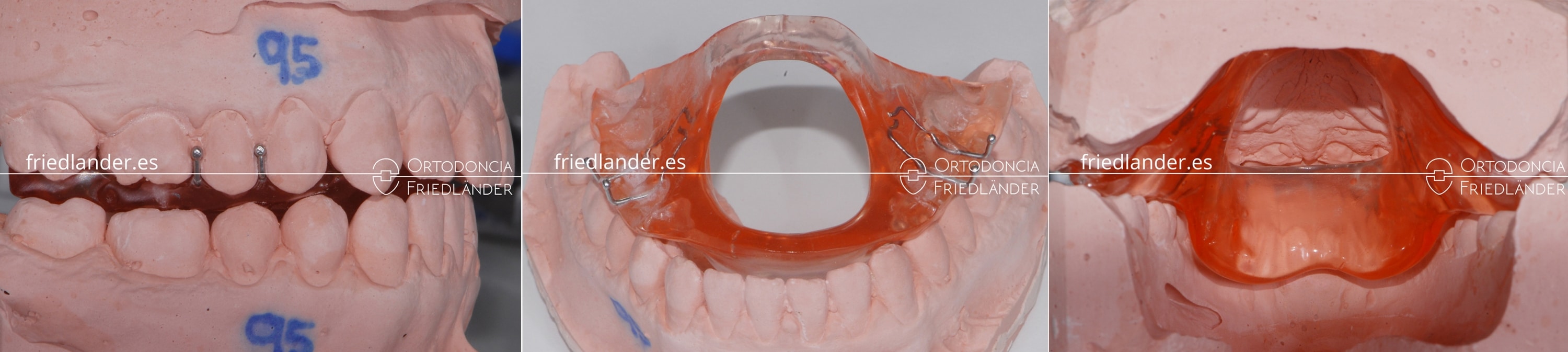 Ortodoncia Friedlander Barcelona mordida abierta microtornillos