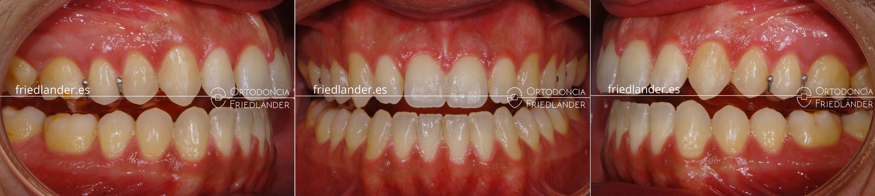 Ortodoncia Friedlander Barcelona mordida abierta microtornillos