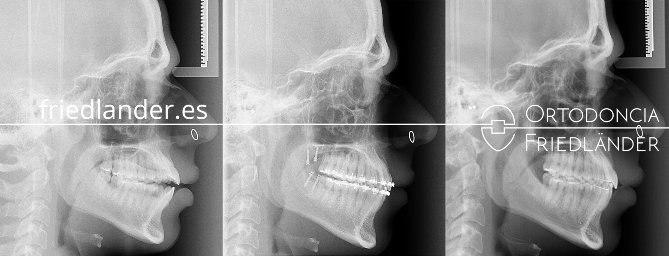  Ortodoncia Friedlander Barcelona mordida abierta microtornillos