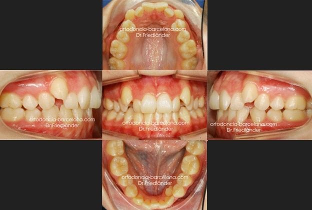 Caso 15 Tratamiento con brackets de autoligado y elásticos (Clase II)