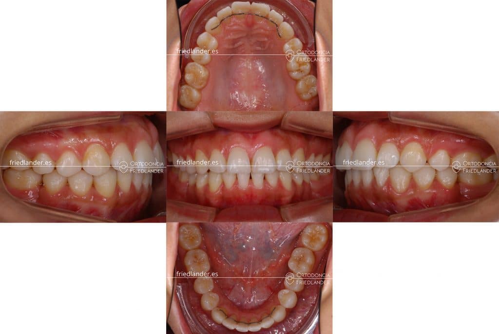 Tratamiento de ortodoncia para cerrar espacios de molares con brackets de autoligado – Caso 45