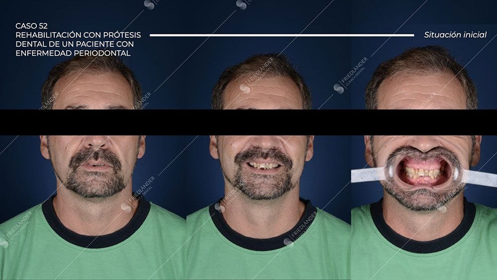 Caso 52 – Rehabilitación con prótesis dental de un paciente con enfermedad periodontal
