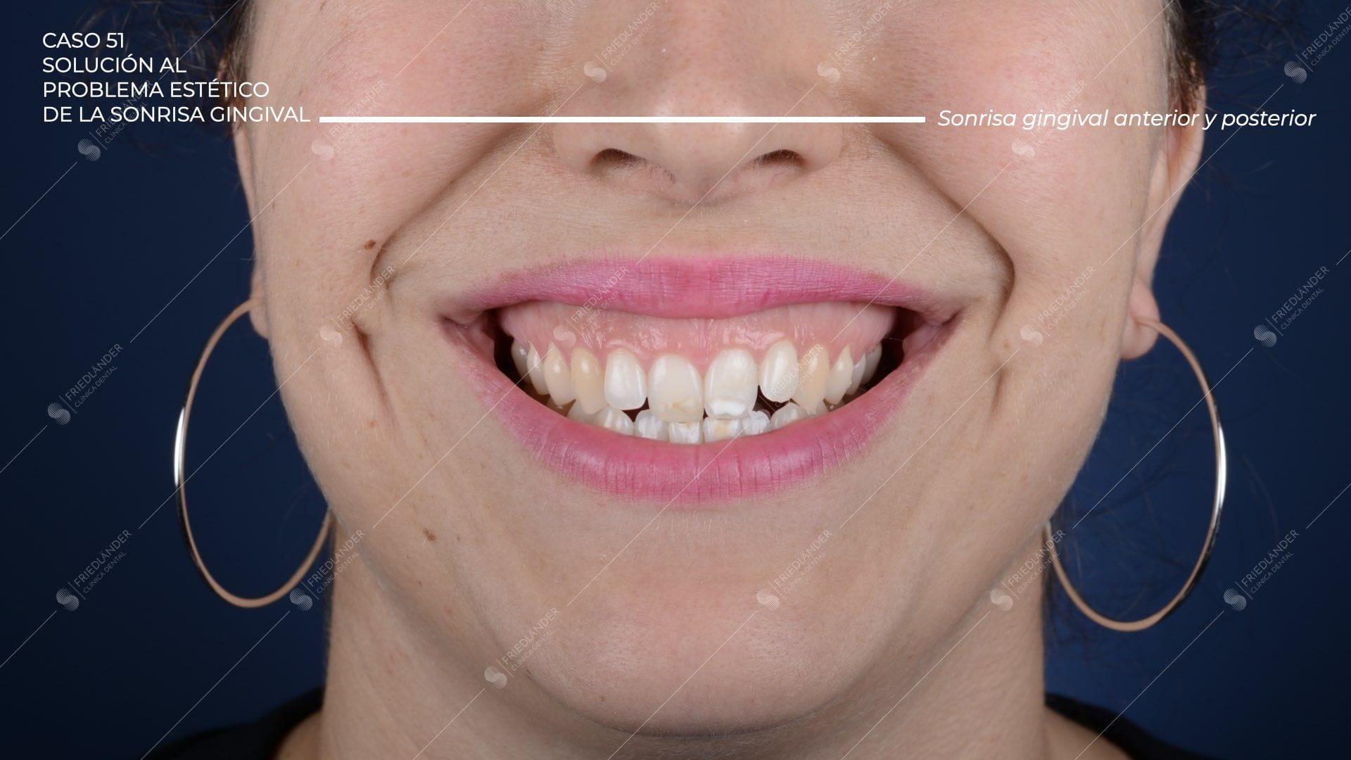 Caso 51 – Solución al problema estético de la sonrisa gingival