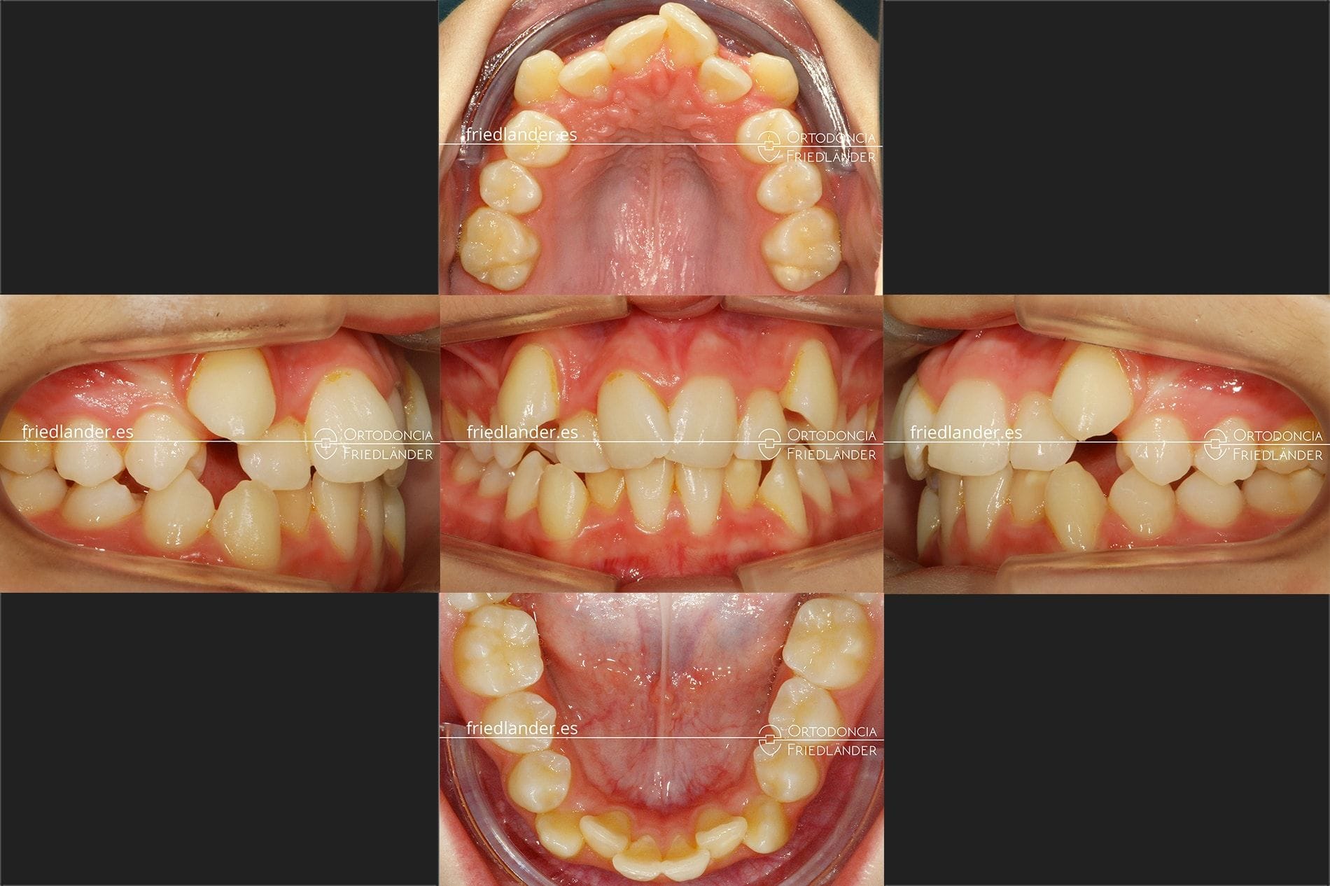 Tratamiento con expansión palatina con disyuntor y brackets convencionales (Apiñamiento, arcada estrecha y caninos altos) – Caso 34