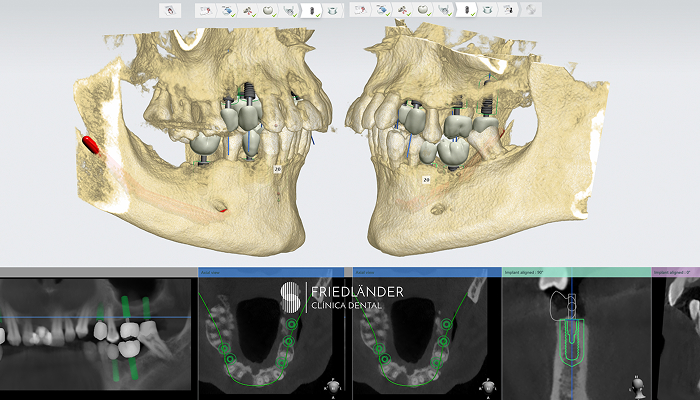 Dra. Marta Montserrat Bosch, especialista en regeneración ósea e implantes dentales en Barcelona · Clínica Friedländer